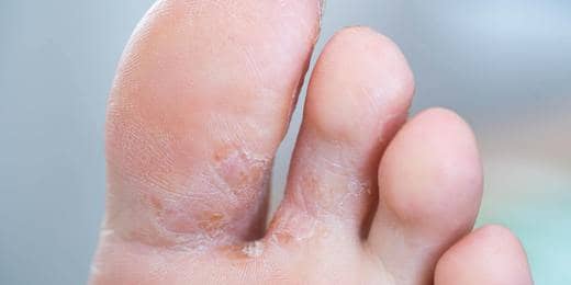 Top Easy Tips to Prevent Fungal Infection with GreenOpia Naturals Natural Oils